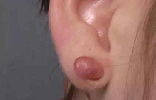 queloide na orelha