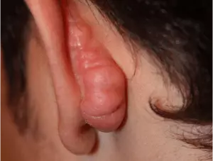 queloide nas orelhas