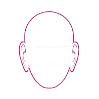 ilustração mostrando como que a macrotia (cirurgia de orelhas grandes) funciona, reduzindo verticalmente o tamanho das orelhas.