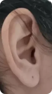 orelha grande, antes de realizar a macrotia