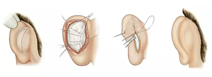 sequencia de Ilustrações mostrando o processo de como é feita a otoplastia. Na primeira imagem é feita uma marcação do corte, na segunda é feito o corte, na terceira mostra como que é feito a costura e na ultima mostra como fica a orelha após o procedimento.