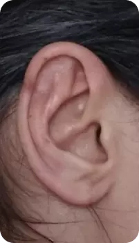 orelha com tamanho normal, depois de realizara a macrotia