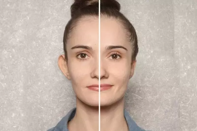2 Fotos de uma mulher sorridente divididas no meio, com cada metade mostrando o resultado de antes e depois da otoplastia. Na imagem de antes a mulher está com orelhas de abano e na imagem de depois as orelhas estão menos abertas.