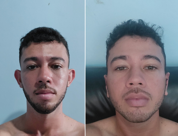 Dr. Andre Ricardo Otoplastia