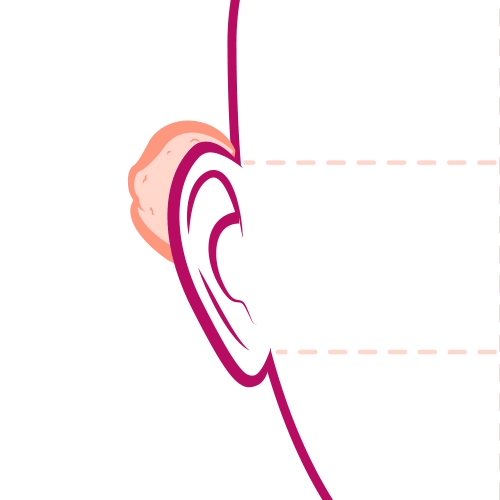 remoção de queloide nas orelhas