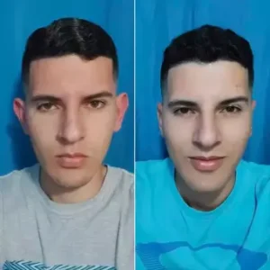 otoplastia antes e depois