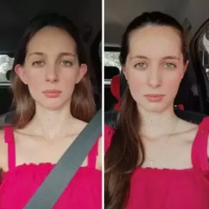 otoplastia antes e depois