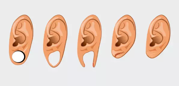 lóbulo de orelha