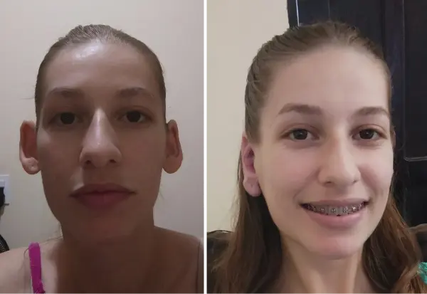 Antes e depois otoplastia Dr. André Ricardo