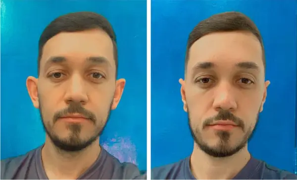 otoplastia Dr. André Ricardo