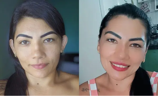 antes e depois da Otoplastia Dr. Guilherme Augusto
