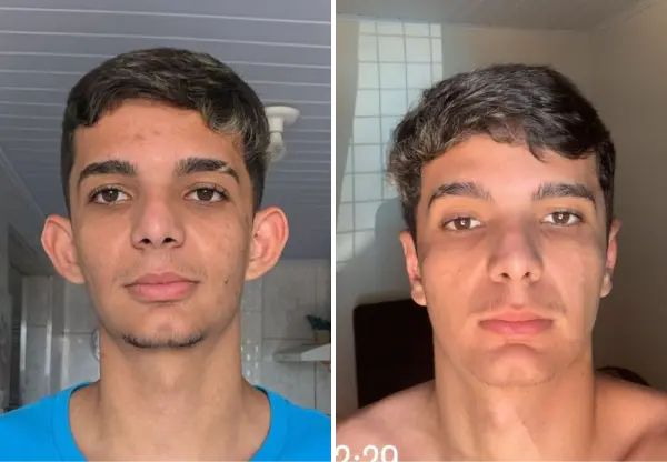 Antes e depois otoplastia Dr. Leandro Ricciluca