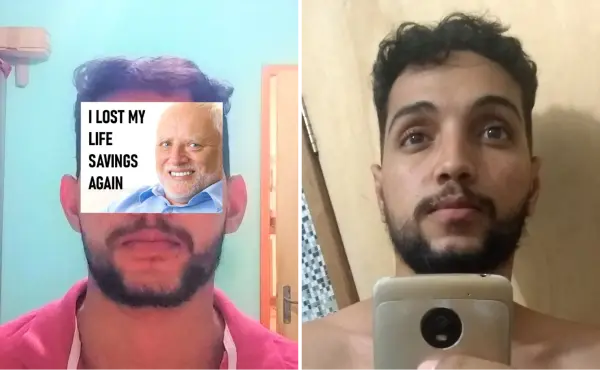 Antes e depois da otoplastia Dr. Lucas Macedo