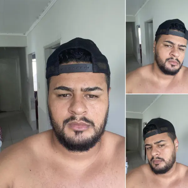 Antes e depois da otoplastia Dr. Lucas Macedo