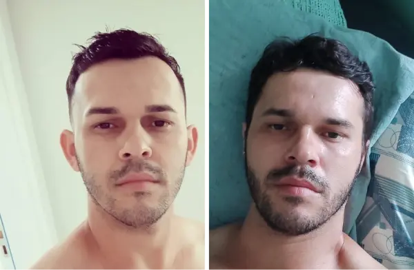 Antes e depois otoplastia Dr. Marcelo Ricardo