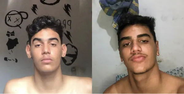 Antes e depois da otoplastia Dr. Victor Barbosa