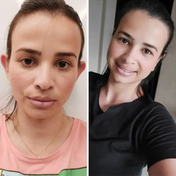 Antes e depois otoplastia Dra. Ludmila Almeida