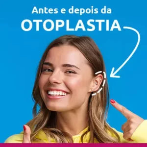 antes e depois da otoplastia