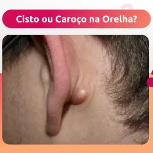 caroco-na-orelha caroço na orelha