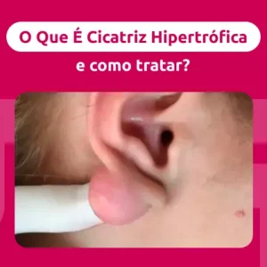 como tratar cicatriz hipertrófica