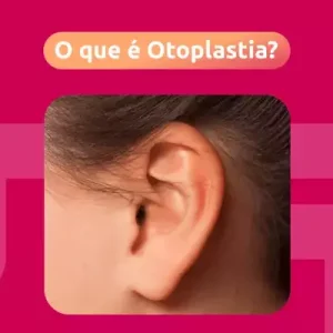 o que é otoplastia