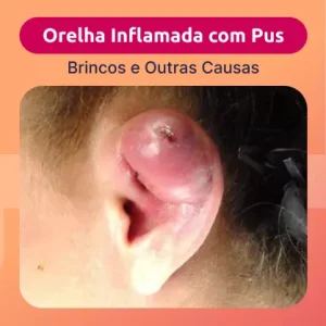orelha-inflamada-com-pus orelha inflamada com pus