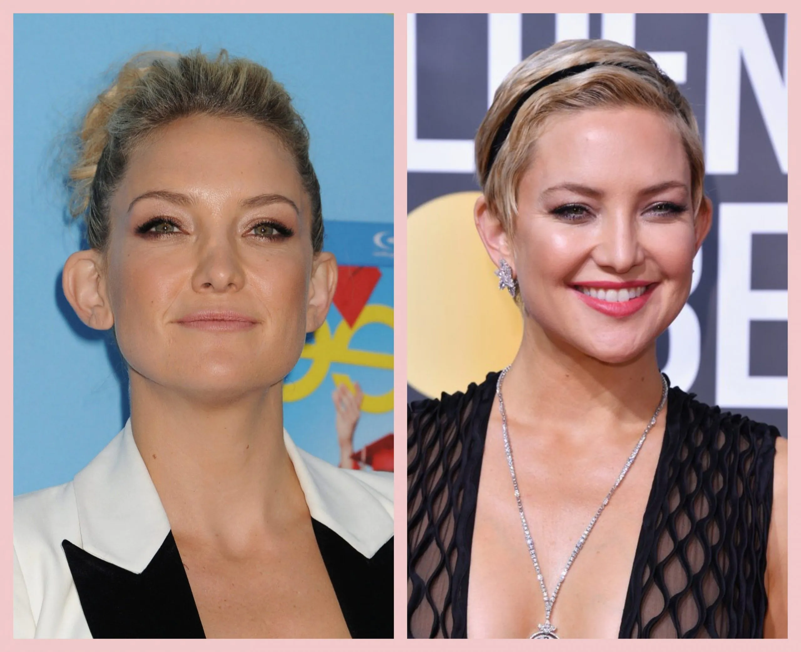 Antes e depois da otoplastia Hate Hudson Otoplastia