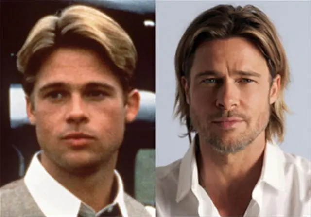 Antes e depois da otoplastia Brad Pitt Otoplastia