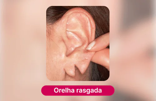 orelha com o lóbulo rasgado